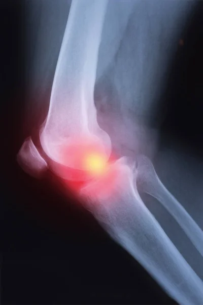 関節炎 リウマチ性関節炎 化膿性関節炎 変形性膝関節症膝の医療用 線膝継手画像 — ストック写真