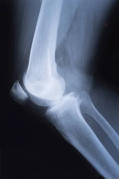 膝の医用 線画像 — ストック写真