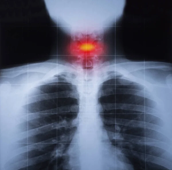 Röntgenbild Von Brust Und Gebärmutterhalstrauma Rot Hervorgehoben — Stockfoto