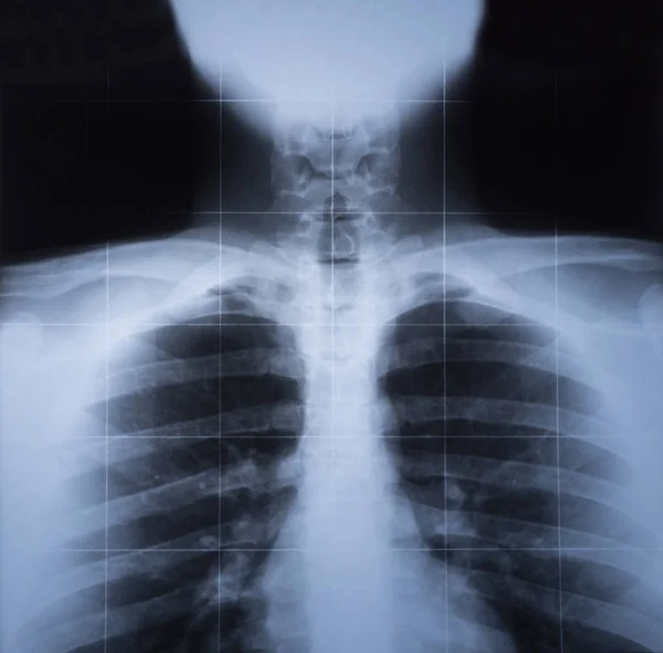 Röntgenbild Des Menschlichen Brustkorbs — Stockfoto