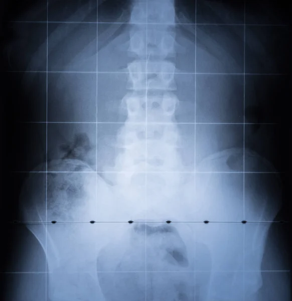 Röntgenbild Der Wirbelsäule Und Des Beckens Des Menschlichen Körpers — Stockfoto
