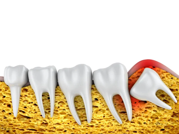 Dental Row Molars Improperly Located Wisdom Tooth Rendering — Stock Photo, Image