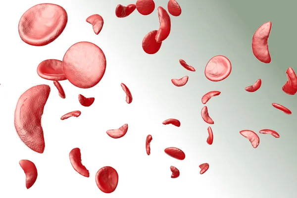 Sickle Cell Anemia 3D Illustration — Stock Photo, Image