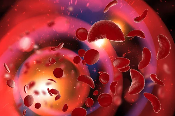 Niedokrwistość Sierpowatokrwinkowa Scd Komórki Krwi Ilustracja — Zdjęcie stockowe