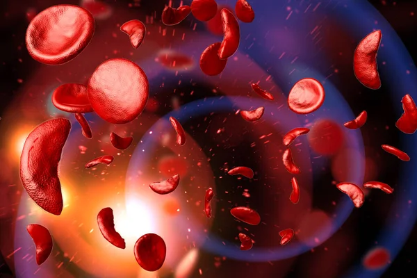 Orak Hücre Anemi Hastalığı Scd Kan Hücreleri Boyutlu Illüstrasyon — Stok fotoğraf