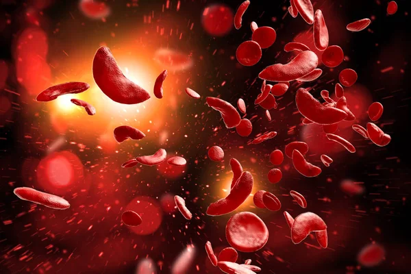 镰状细胞贫血症 Scd 血细胞3D图例 — 图库照片