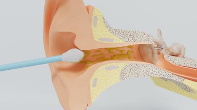 Pamuk bez kullanarak doğru şekilde. Kulak balmumu Temizleme. İç kulak modeli.