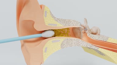 Pamuklu çubukla kullanmanın yanlış yolu. Kulak balmumu blokaj oluşumu. İç kulak modeli.