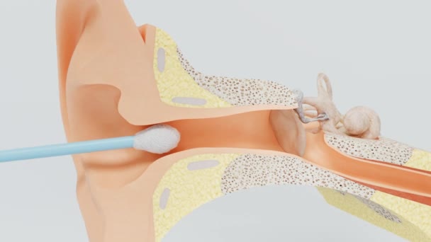 棉拭子的不准确运动使耳膜流泪 听力膜破裂引起的听力损失 — 图库视频影像