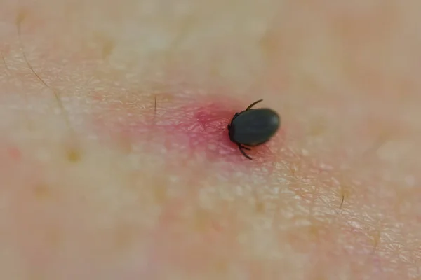 Tick bite Images - Search Images on Everypixel