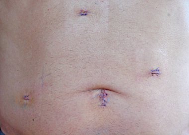 3 Day old scars of Laparoscopic Cholocystectomy Operation to remove Gall Bladder with symptomatic gall stones clipart