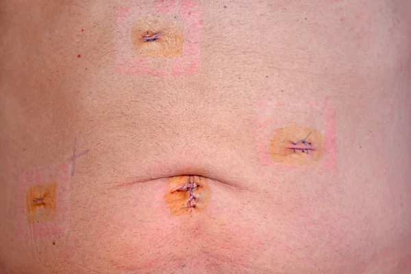 Cicatrizes Dias Operação Colocistectomia Laparoscópica Para Remover Vesícula Biliar Com — Fotografia de Stock