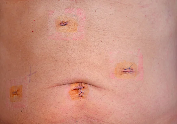 Cicatrizes Dias Operação Colocistectomia Laparoscópica Para Remover Vesícula Biliar Com — Fotografia de Stock