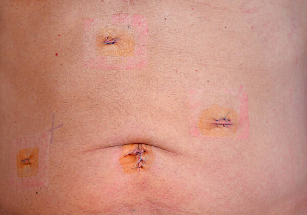 3-дневные шрамы от лапароскопической холоцистэктомии Операция по удалению желчного пузыря с помощью симптоматических желчных камней
