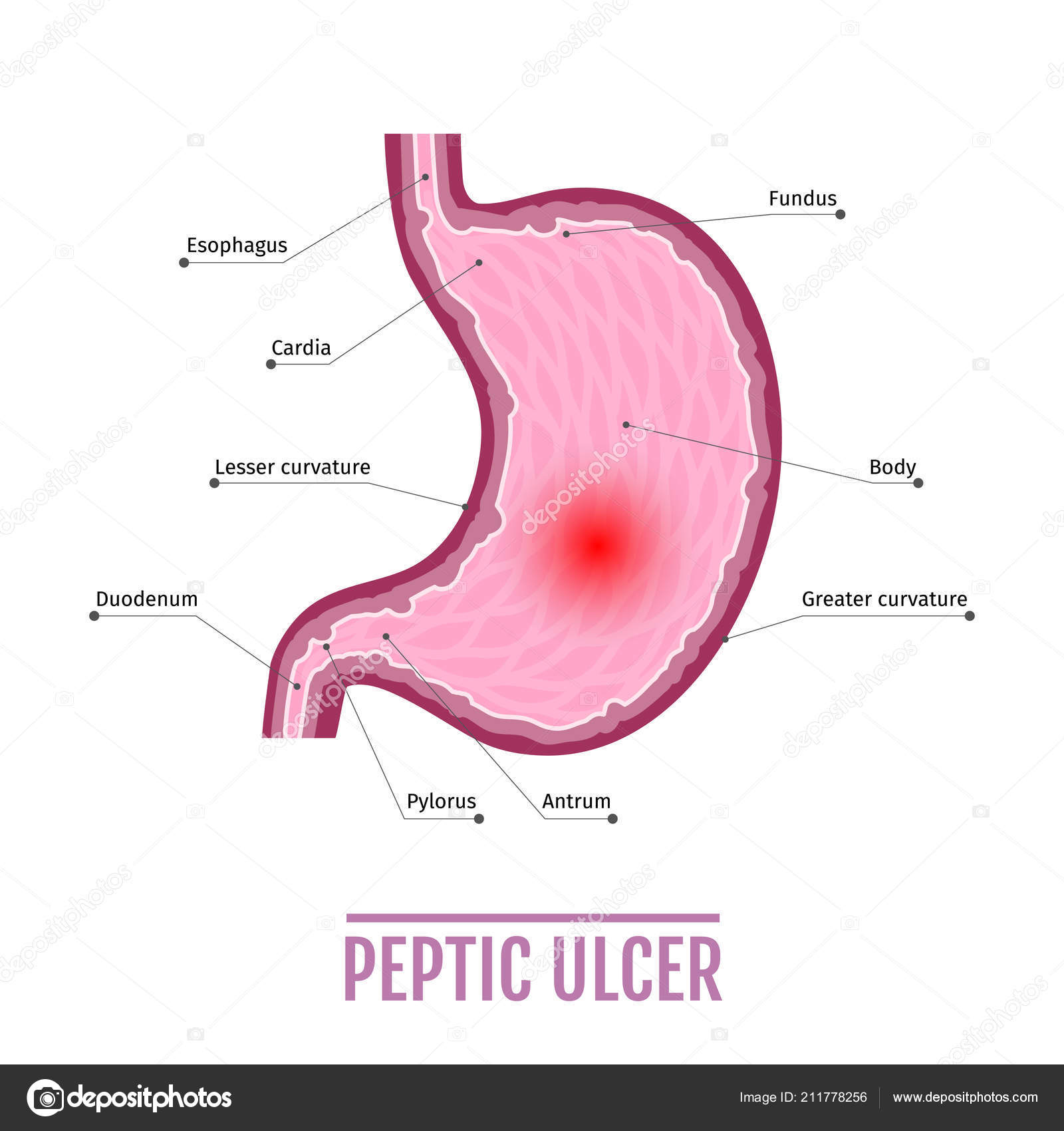 Que significa ulcera en el estomago