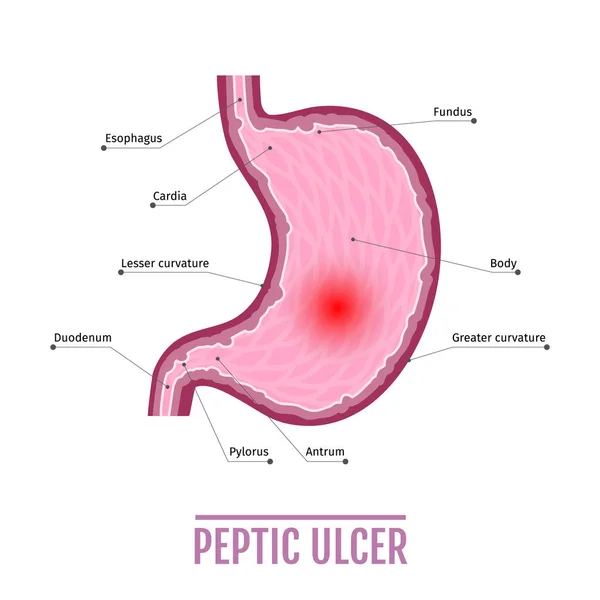 Ilustración Médica Del Estómago Humano Con Úlcera Péptica Esquema Para — Vector de stock