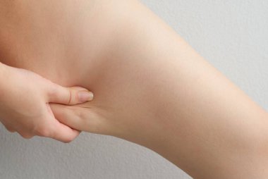 Selülit kadın bacağı uyluk. Cilt sorunu, vücut bakımı, şişmanlık ve diyet kavramı, diyabetik risk facto