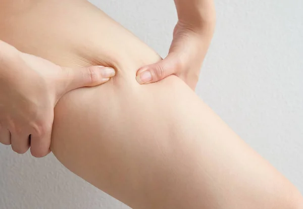 Μηροί Γυναικεία Πόδια Κυτταρίτιδα Δέρμα Πρόβλημα Έννοια Σώματος Περιποίηση Του — Φωτογραφία Αρχείου