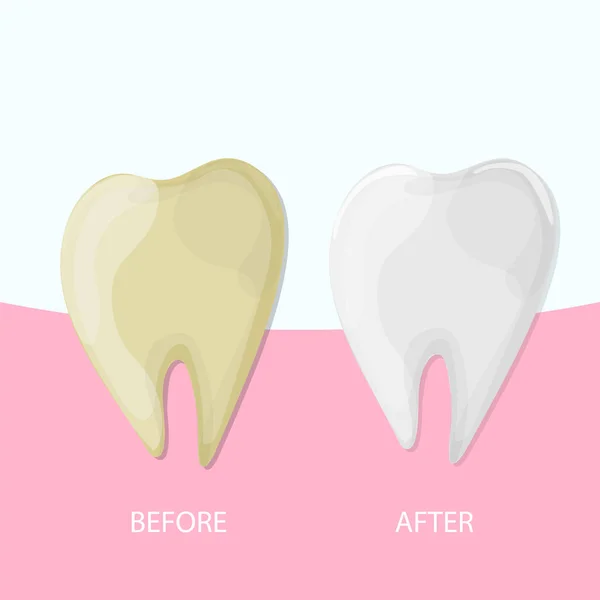 Blanqueamiento dental profesional, Diente sano y amarillo, ilustración vectorial — Vector de stock