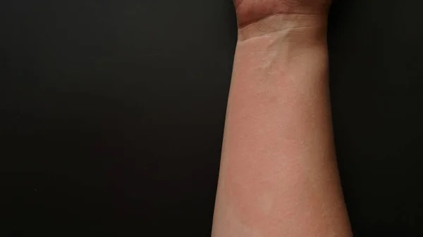 Vrouwelijke hand bedekt met rode vlekken, close-up. Allergische reactie — Stockfoto