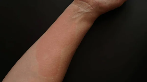 Mano femenina cubierta de manchas rojas, primer plano. Reacción alérgica — Foto de Stock