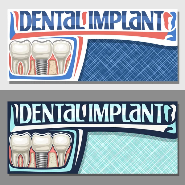 Векторные Баннеры Зубного Импланта Копировальным Пространством Макеты Карикатурными Человеческими Зубами — стоковый вектор