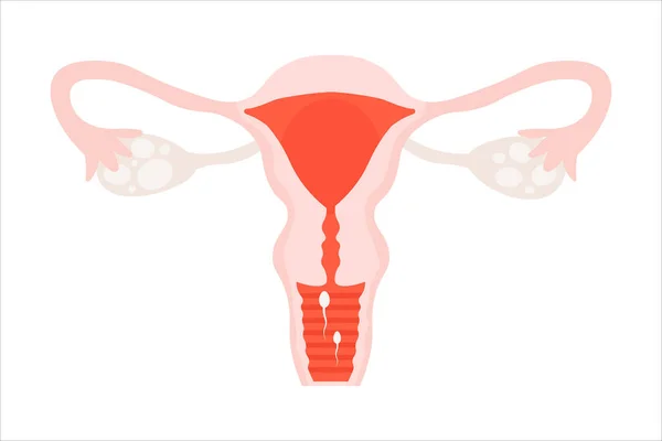Vektor Flach Gebärmutterorgan Der Frau Mit Sperma — Stockvektor