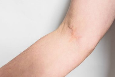 Beyaz arka planda ameliyat üstüne ameliyat. Kan naklinden sonraki yara izi. Lazer yara azaltma konsepti.