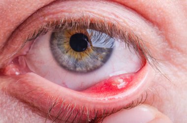 Stye (hordeolum) disease on eye of a caucasian female clipart