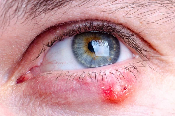 Stye Hordeolum Ziekte Oog Van Een Kaukasische Vrouw — Stockfoto