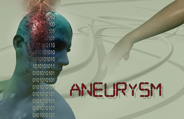 Medizinische Illustration Von Gehirn Aneurysma — Stockfoto