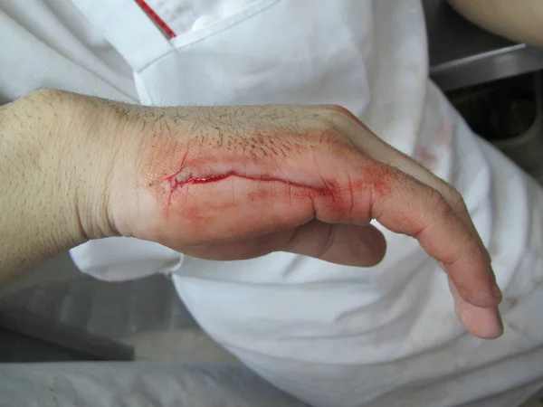 Hand injury