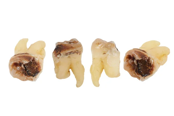 Dente com cárie dentária — Fotografia de Stock