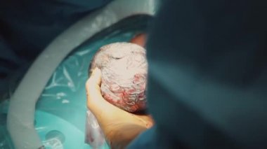 Yakın sezaryen doğum cerrahisi. doktorlar elleri cerrahi eldiven giyen ameliyat ekibi koruyucu giyim sezaryen doğum cerrahisi operasyonu sırasında steril ekipman kullanarak ameliyat gerçekleştiren