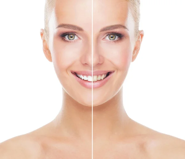 Ząb Wybielaniu Procedury Przed Porównaj Oblicze Piękna Kobieta Białym Tle — Zdjęcie stockowe