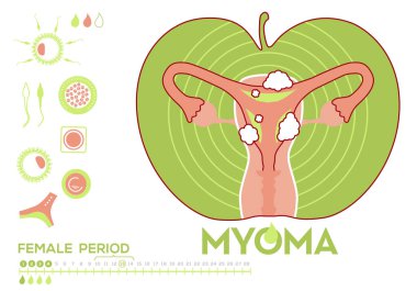 Medicine info-graphic about myoma, menstrual cycle of a woman health, hygiene, vector, white background, character set   clipart