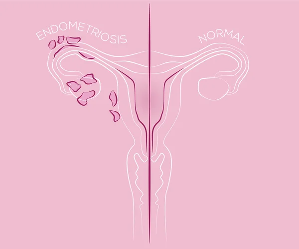 Ilustração Endometriose Tecido Endometrial Útero Doença Feminina —  Vetores de Stock