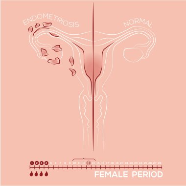 Endometriyozis, rahim içi dokular, kadın hastalıkları, kadın ilaçları, adet dönemi.