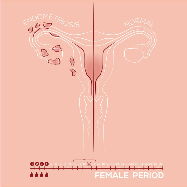 Illustration of endometriosis, endometrial tissue in the uterus, female disease, womens medicine, menstrual period