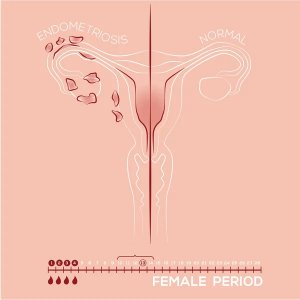 子宫内膜异位症 子宫内膜组织 女性疾病 女性药物 经期的病媒说明 — 图库矢量图片