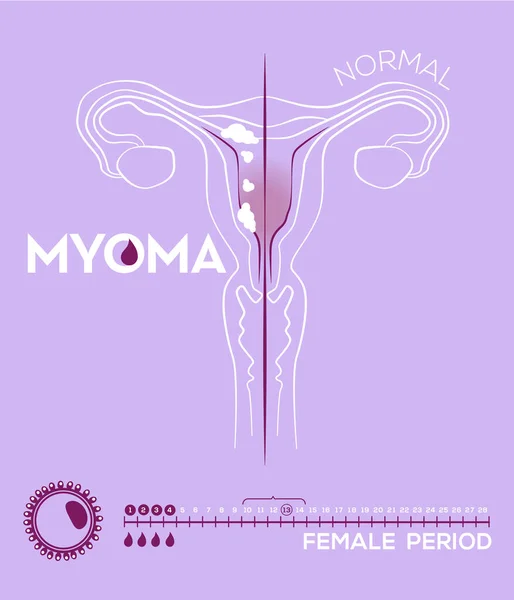 Medicína Info Grafika Myomu Menstruační Cyklus Zdraví Žen Hygiena Ilustrace — Stockový vektor