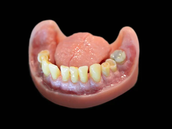 Dentes Estomatologia Modelos Modelo Educação Odontológica Com Prótese — Fotografia de Stock