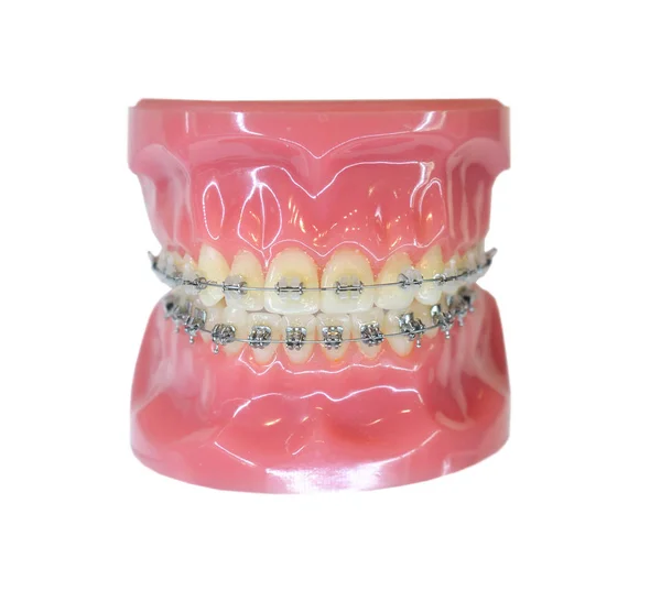 矯正歯半分セラミックと歯科医学教育モデル顎をモデル化し 半金属ブラケットの歯と顎モデル — ストック写真