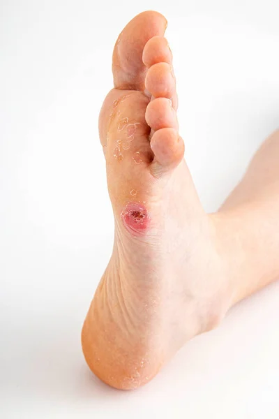 人間の足の上の足のトウモロコシ — ストック写真