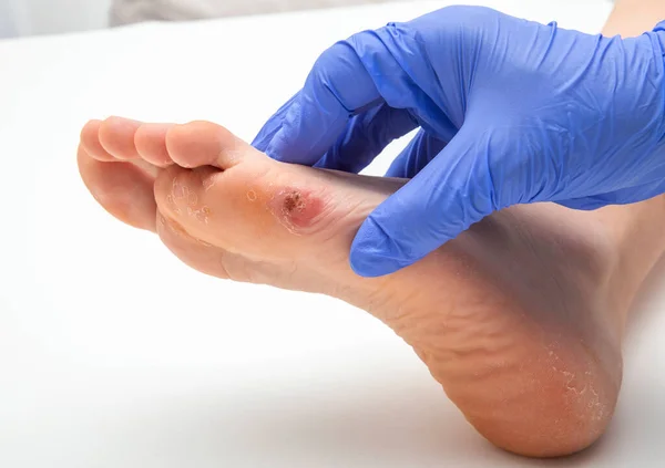 Doktor Vyšetřuje Ženskou Lidskou Nohu Kukuřicí Nohou — Stock fotografie