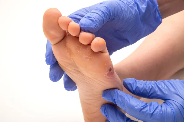 Doktor Vyšetřuje Ženskou Lidskou Nohu Kukuřicí Nohou — Stock fotografie
