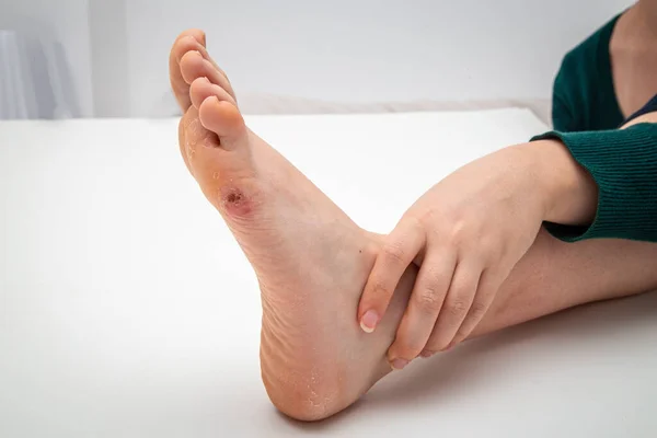 Foot Corn Human Leg — Stock Photo, Image