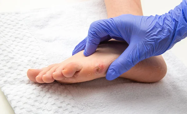 足のトウモロコシと女性の人間の足を調べる医師 — ストック写真