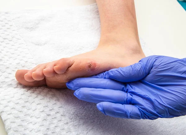 Arzt Untersucht Weibliches Menschenbein Mit Fußmais — Stockfoto