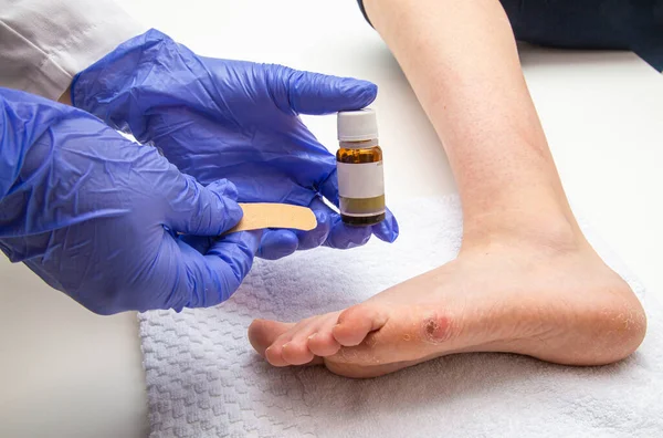 Medizinische Behandlung Von Fußpilz — Stockfoto